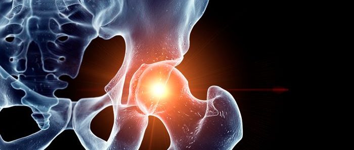 hip fractures bone image